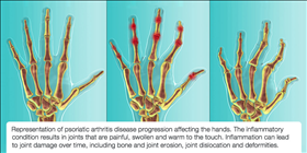 Psoriatic Arthritis Disease Progression Affecting the Hands 