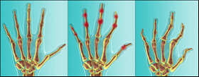 Representation of Psoriatic Arthritis Disease Progression Affecting the Hands