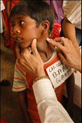 Babu, a Boy in India Being Screened for Leprosy