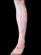 Plaque Psoriasis - Leg 