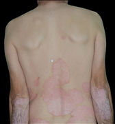 Plaque psoriasis - Back 
