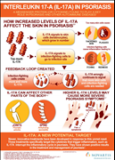 IL-17A in Psoriasis Infographic